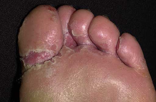 The toes of a foot with athlete's foot