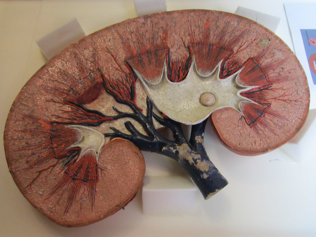 kidney-stone-cross section1