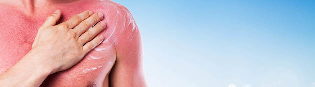 Man rubbing cream onto hes sunburned shoulder