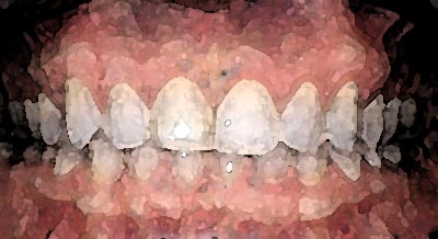 Gum Disease Close Up