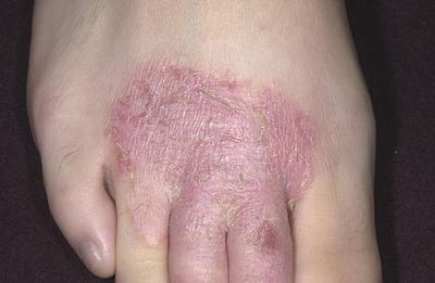 Eczema on the top of the foot
