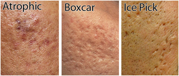 Three acne scar types - atrophic, boxcar and Ice pick