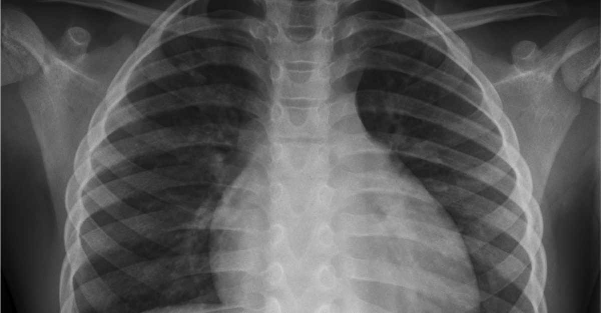 chest congestion x-ray