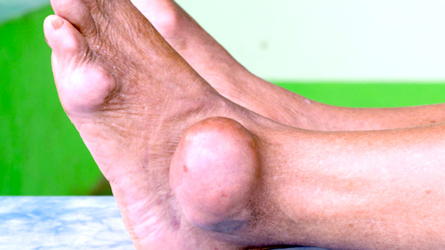 How can you use diet as a remedy for gout in your foot?