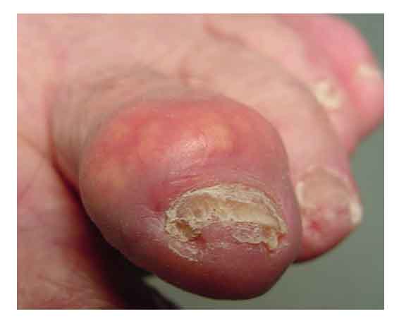 gouty-arthritis-toe