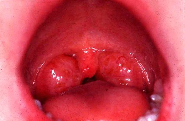 swollen-uvula-sore-throat