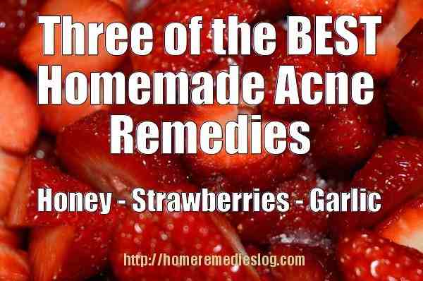 3 best homemade acne remedies - meme