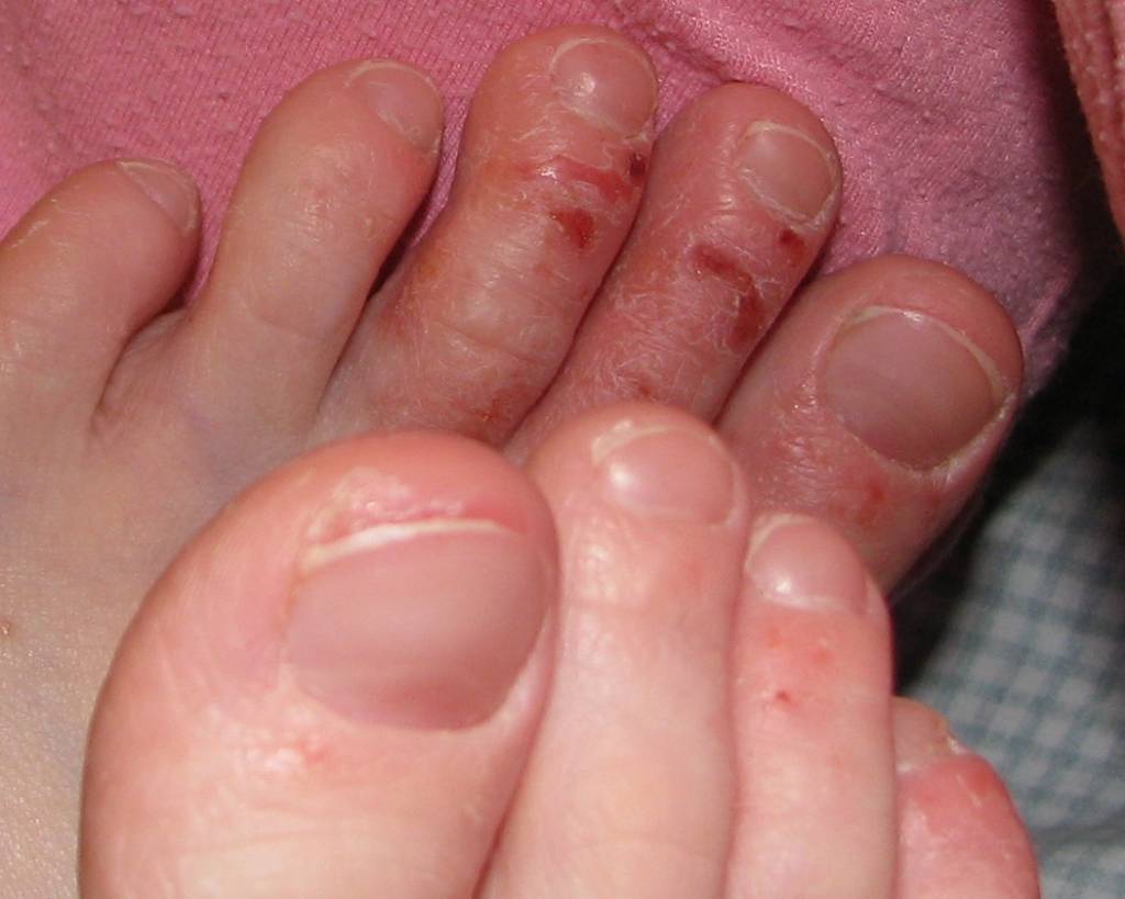 close-up photo Eczema showing on toes