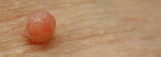 close-up of one round shaped skin tag