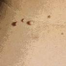 Home Remedies for Skin Tags – A Definitive Guide
