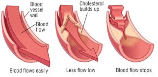 diagram showing how cholesterol affects blood-flow