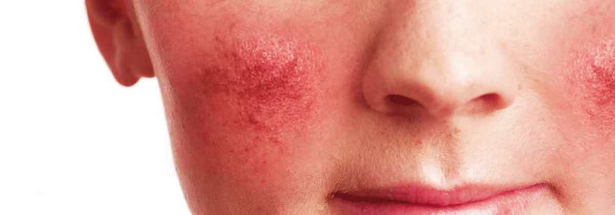 Rosacea on Face Cheek