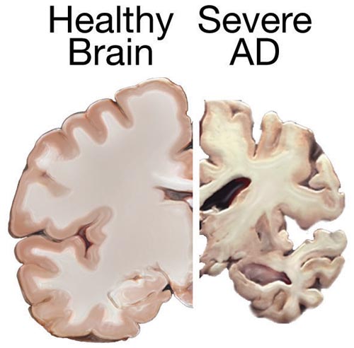 Natural Alzheimer’s Prevention Remedies