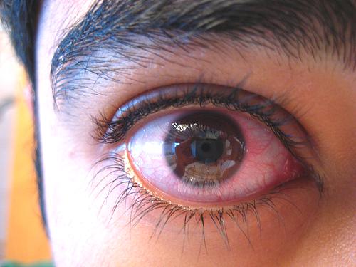 Conjunctivitis of the eye close up photo