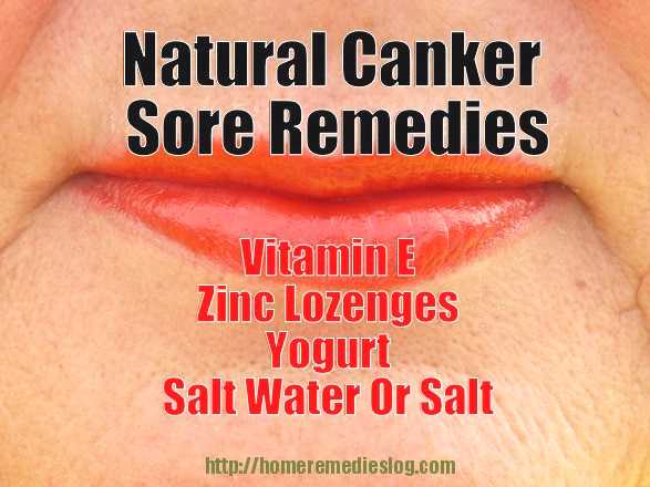 What is a cure for a canker sore?