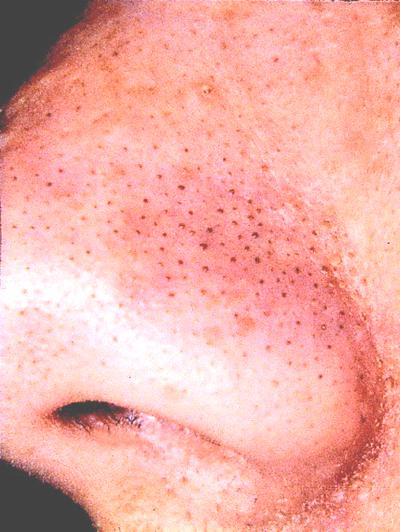 Extreme close-up of blackheads on the nose