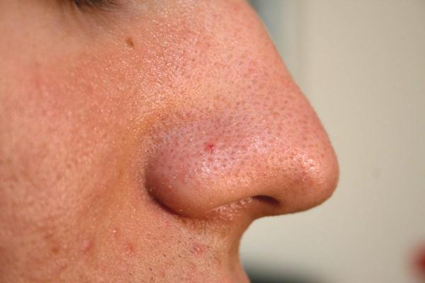 Close up cross section of blackheads on nose