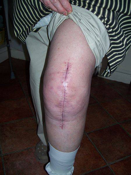 Total_knee_replacment_scar