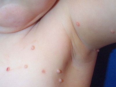 Many Warts under the arm of a child