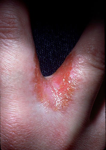 yeast infection between fingers
