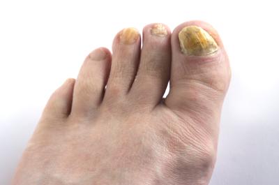 Yellow Toenails