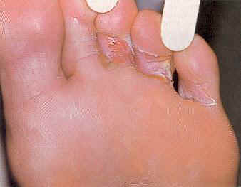 Close-up of athlete's foot condition