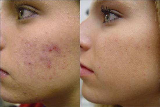 before+after+acne+remedies