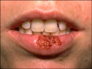 Infected canker sore showing on bottom lip