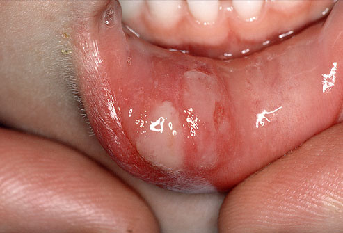 canker sore showing on the inside of lower lip