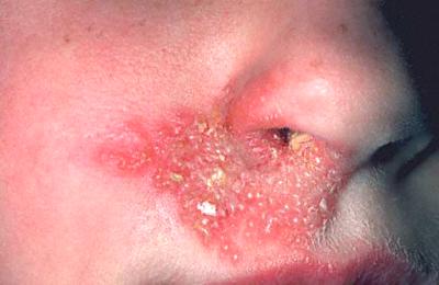 severe case of cold sores infection around lower nose area
