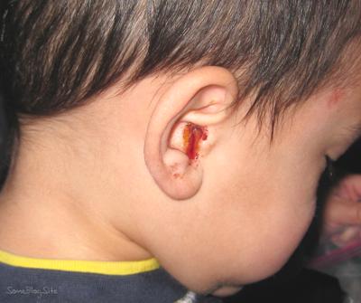 ear infection signs in child - blood in the ear