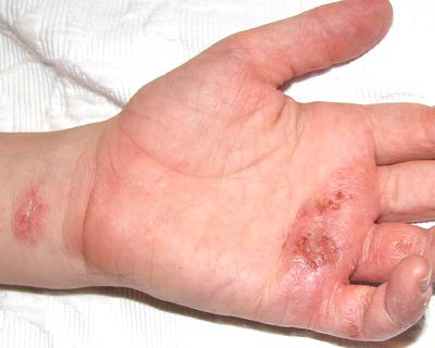 hand with eczema on palm
