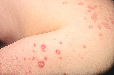 eczema spots on the skin surface of upper body
