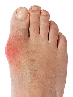 gout-foot