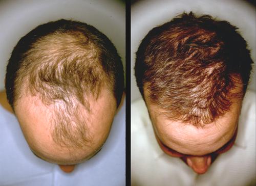 hair growth stimulation results on man before and after