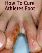 how to cure athletes foot