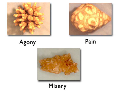 3 types of kidney stones