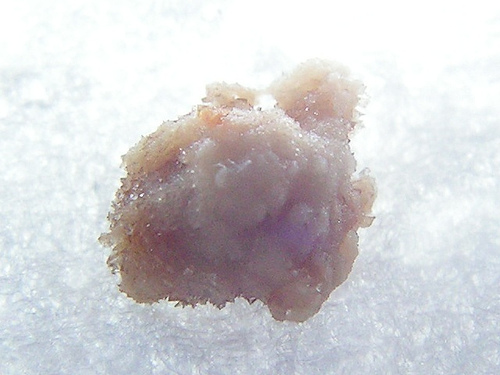 kidney-stone image