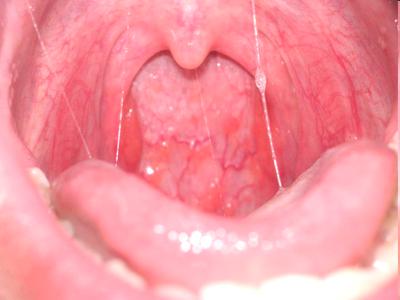 laryngitis