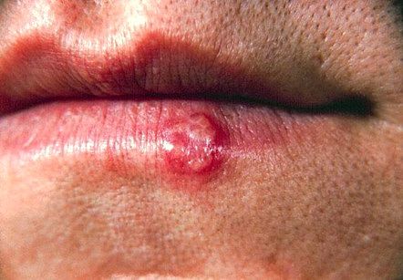 close-up of lower lip showing a single cold sore