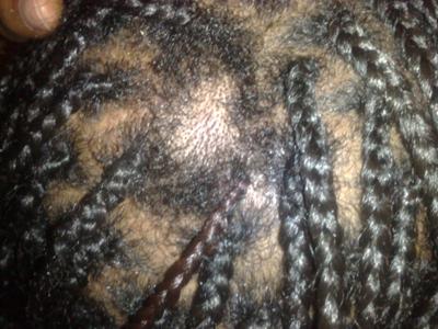 raw dry scalp