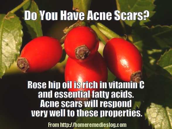 rose hip for acne scars - meme