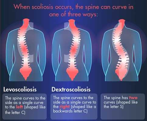 Scoliosis Information