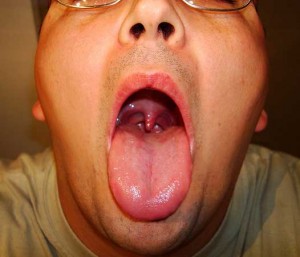 open mouth showing sore throat