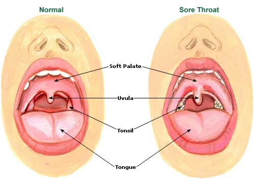 sore throat diagram comparing normal throat to sore throat