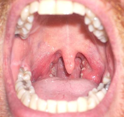 strep_throat_Oral Health