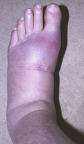swollen-foot-with-gout