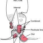 Hemorrhoid Diagram