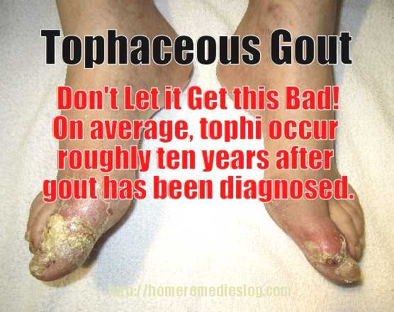 tophaceous gout - meme