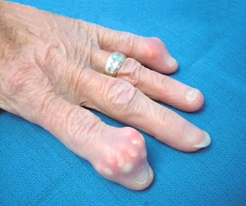 tophaceous gout of the fingers